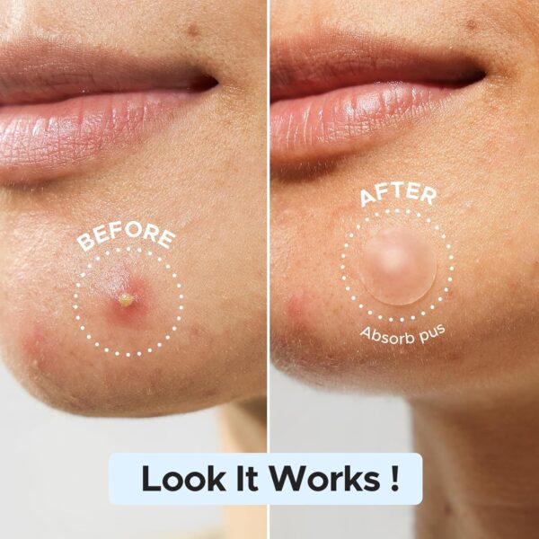Pimple Patches - Image 3